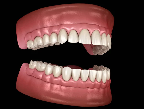 インプラントでサポートされている4つのシステム上のすべてのガムで上顎および顎関節の義肢 人間の歯と入れ歯の医学的に正確な3Dイラスト — ストック写真