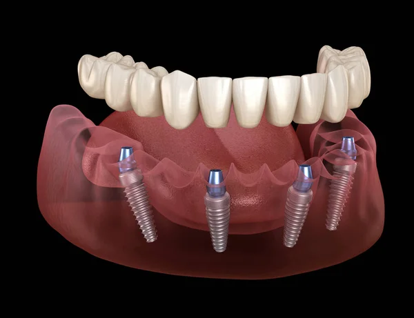 Mandibulaire Prothese Alles Systeem Ondersteund Door Implantaten Medisch Nauwkeurige Illustratie — Stockfoto