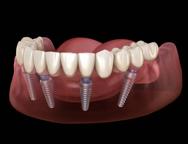 下颌骨假体全部安装在由植入物支撑的4个系统上 医学上准确的人类牙齿和假牙概念三维图像 — 图库照片