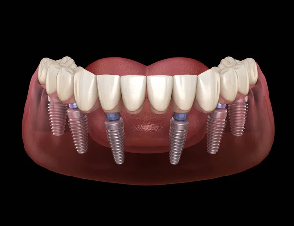 人工授精インプラントでサポートされている6つのシステムのすべて 人間の歯と入れ歯の概念の医学的に正確な3Dイラスト — ストック写真