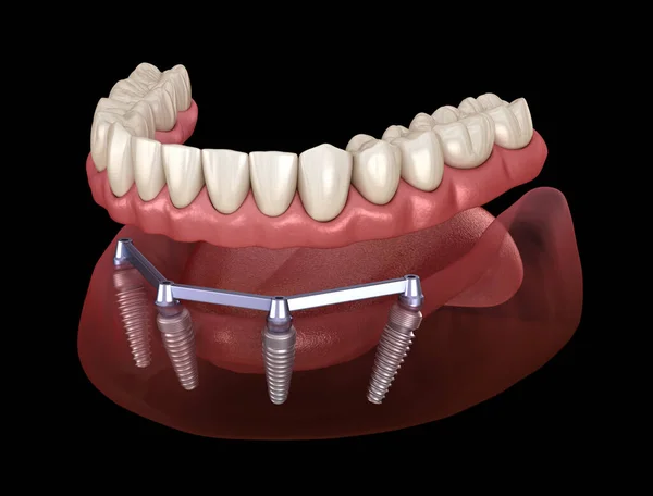 下颌骨假体与牙龈全部在4个系统支持植入物 医学上准确的人类牙齿和假牙概念三维图像 — 图库照片