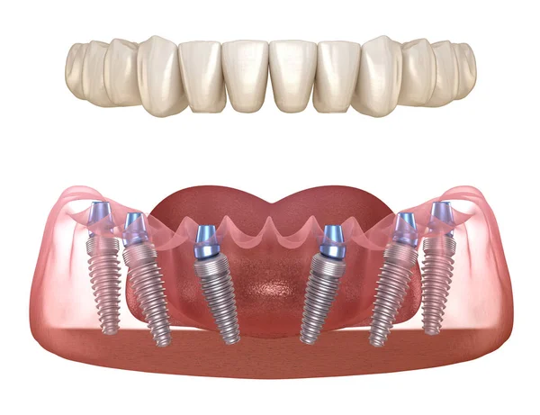 Mandibulaire Prothese Alles Systeem Ondersteund Door Implantaten Medisch Nauwkeurige Illustratie — Stockfoto