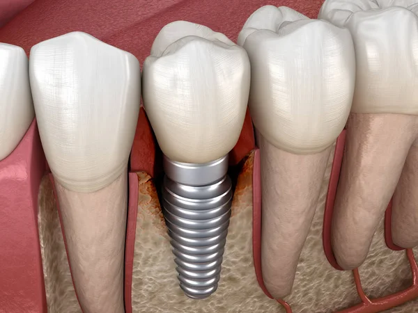 Перімоплантит Видимими Пошкодженнями Кісток Медично Точна Ілюстрація Концепції Зубних Імплантатів — стокове фото