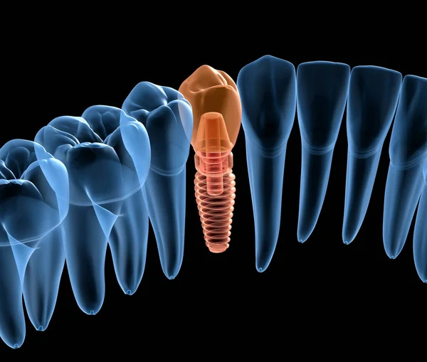 Recupero Dei Denti Con Impianto Vista Raggi Illustrazione Clinicamente Accurata — Foto Stock
