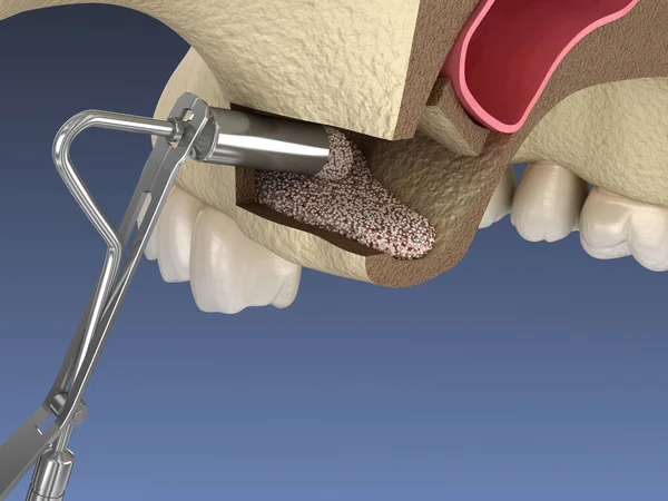 Sinus Lift Surgery Hinzufügen Neuer Knochen Illustration — Stockfoto