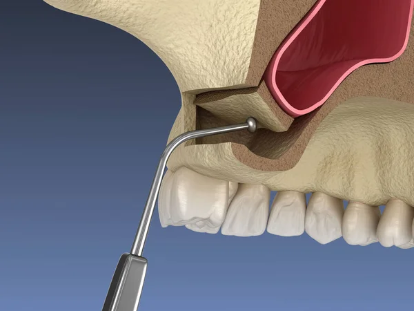 Cirurgia Elevação Sinusal Membrana Sinusal Movimento Ilustração — Fotografia de Stock