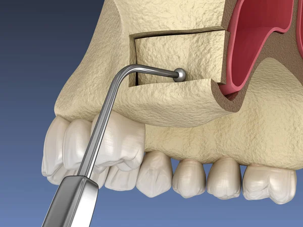 Sinus Lift Surgery Schaffung Eines Seitlichen Zugangs Zum Sinus Illustration — Stockfoto