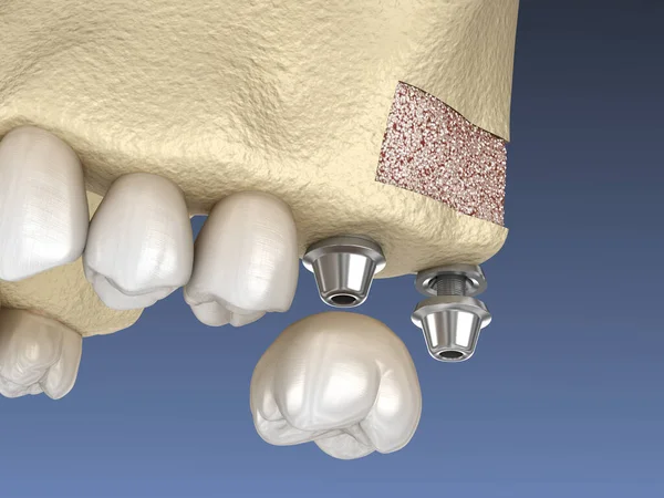 鼻窦升降外科 植入物安装 3D插图 — 图库照片