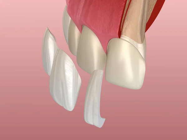 在中央门牙和侧牙上安装嵌板的程序 3D图解 — 图库照片