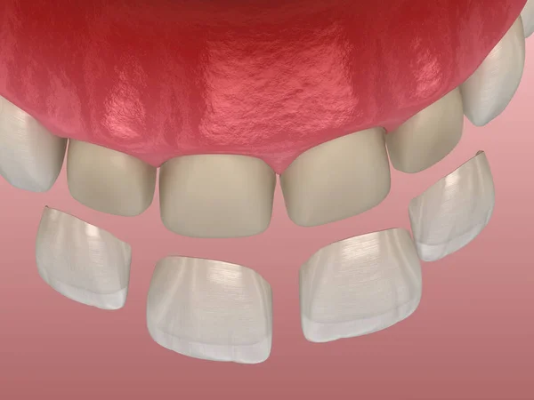 Procedimento Instalação Folheado Sobre Incisivo Central Incisivo Lateral Ilustração Dente — Fotografia de Stock