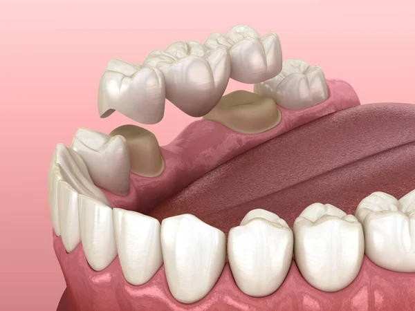 Dental bridge of 3 teeth over molar and premolar. Medically accurate 3D illustration of human teeth treatment