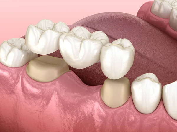 Стоматологічний Міст Трьох Зубів Над Молярним Премолярним Медично Точна Ілюстрація — стокове фото