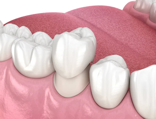 Preparato Dente Premolare Posizionamento Corona Dentale Illustrazione Clinicamente Accurata — Foto Stock