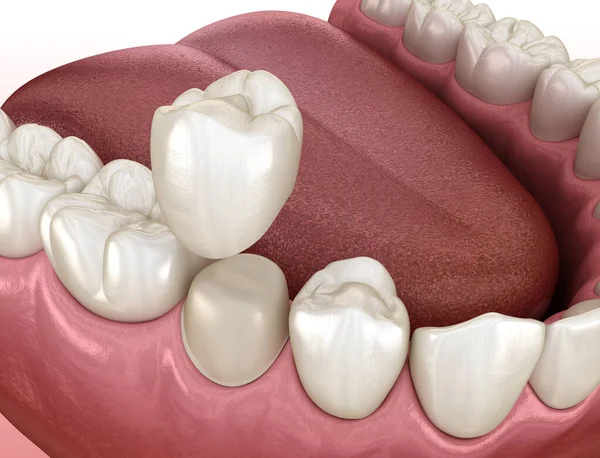 Voorbereide Premolaire Tand Tandheelkundige Kroon Plaatsing Medisch Accurate Illustratie — Stockfoto