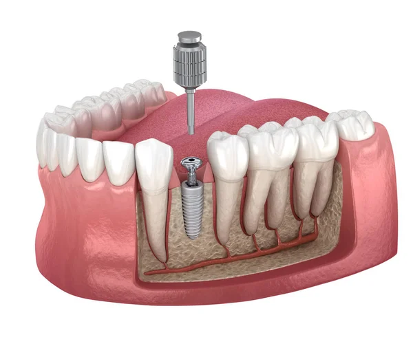 Implantátum Csavarhúzó Fedőcsavaros Rögzítési Eljárást Végez Orvosilag Pontos Illusztráció — Stock Fotó