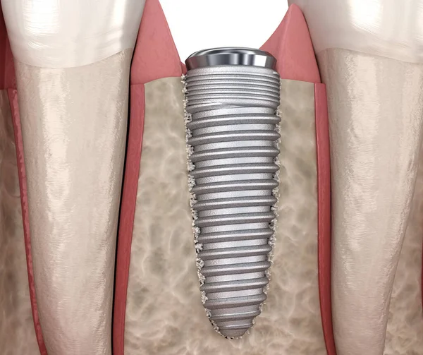 Новий Ріст Кісток Поблизу Імплантату Медично Точна Ілюстрація — стокове фото