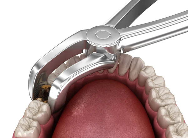 ケアによって損傷を受けたモル歯の抽出 医学的に正確な歯3Dイラスト — ストック写真