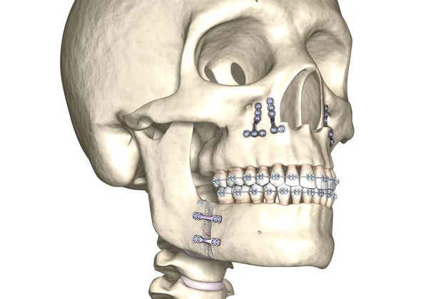 Χειρουργική Επέμβαση Κάτω Γνάθου Ιατρικά Ακριβής Οδοντιατρική Τρισδιάστατη Απεικόνιση — Φωτογραφία Αρχείου