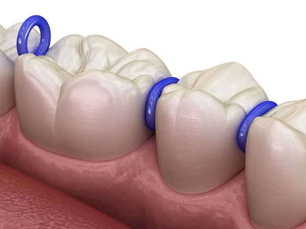Gummiabscheider Zwischen Den Zähnen Vorbereitung Für Die Platzierung Von Zahnspangen — Stockfoto