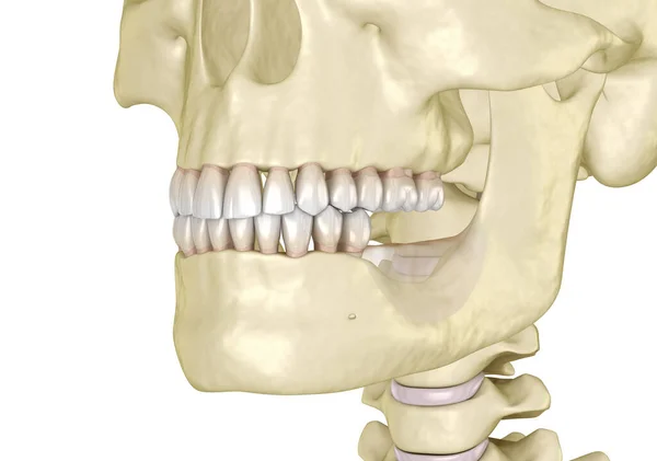 Mandíbula Mandibular Recesión Ósea Después Perder Los Dientes Molares Ilustración — Foto de Stock