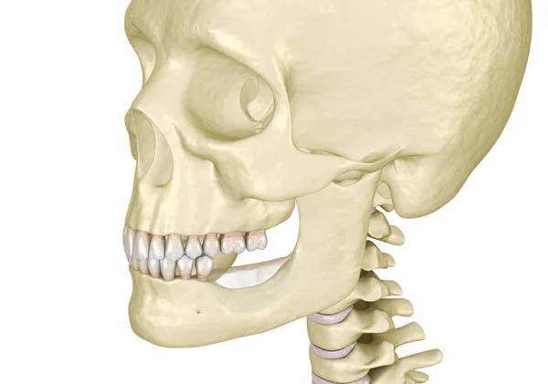 Mandíbula Recessão Óssea Depois Perder Dentes Molares Ilustração Odontológica Medicamente — Fotografia de Stock