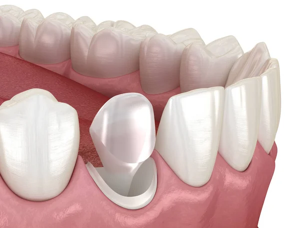 杖の歯にピンのタブをスタンプします 医学的に正確な歯科3Dイラスト — ストック写真