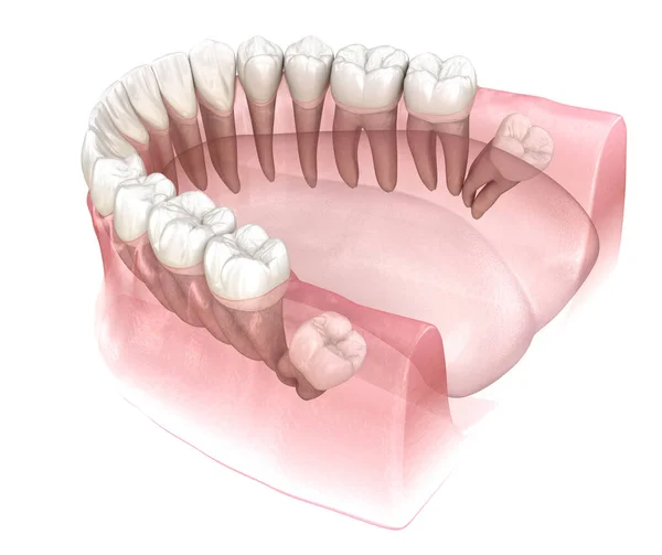 Impacção Distal Dente Sabedoria Ilustração Dente Medicamente Precisa — Fotografia de Stock