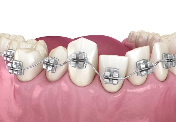 牙齿位置不正常 用金属矫形器矫正错误 医学上准确的牙科3D图像 — 图库照片