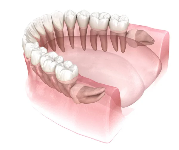 知恵の歯の水平影響 医学的に正確な歯3Dイラスト — ストック写真