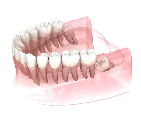 Niedrożność Zębów Mądrości Medycznie Dokładna Ilustracja Zęba — Zdjęcie stockowe