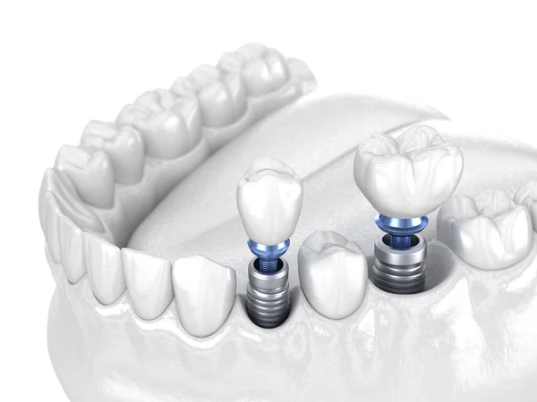 Instalación Corona Dentaria Premolar Molar Sobre Implante Concepto Blanco Ilustración — Foto de Stock