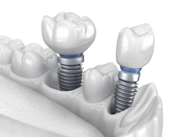 インプラント上の前歯と臼歯の歯冠設置 白の概念 人間の歯や入れ歯の3Dイラスト — ストック写真