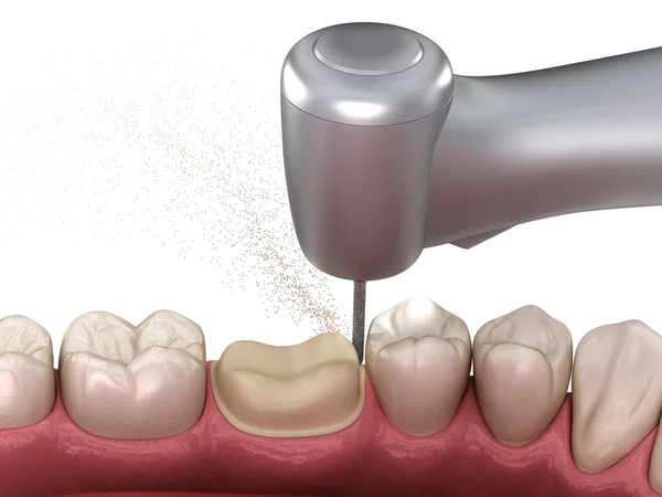 Diş Kaplaması Yerleştirme Için Azı Dişi Hazırlama Işlemi Tıbbi Olarak — Stok fotoğraf