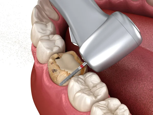 Carie Rimozione Processo Illustrazione Del Dente Clinicamente Accurata — Foto Stock