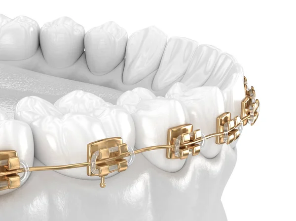 Здорові Зуби Золотими Брекетами Концепція Білих Зубів Ілюстрація Зубів — стокове фото