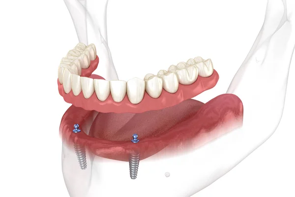 Prótese Removível Mandibular Tudo Sistema Suportado Por Implantes Com Encaixes — Fotografia de Stock