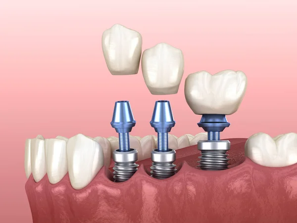 Zahnkronen Platzierung Über Implantate Konzept Darstellung Menschlicher Zähne Und Prothesen — Stockfoto