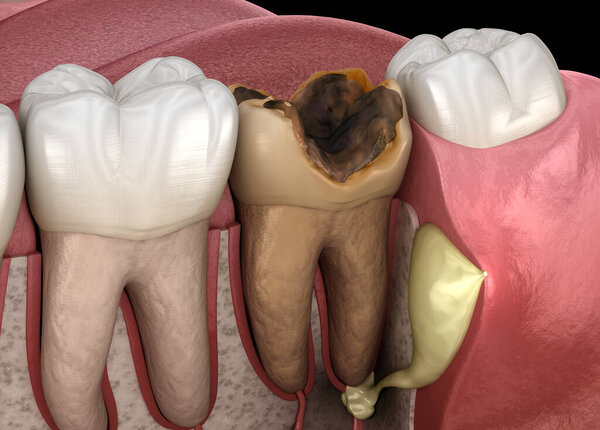 Периостит зуба - Комок на десне выше зуба. Медицинская точность 3D-иллюстрации