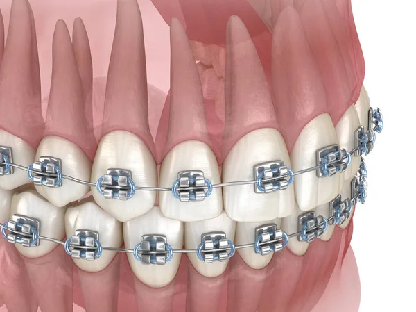 金属ブレースと透明歯科モデル 医学的に正確な3Dイラスト — ストック写真
