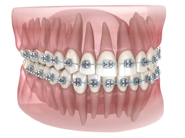 Kovové Výztuhy Transparentní Zubní Model Lékařsky Přesná Ilustrace — Stock fotografie