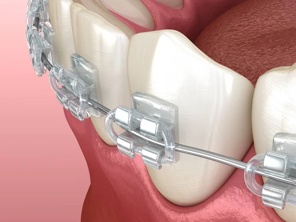Mandibular Jaw Clear Braces Medically Accurate Dental Illustration — Stock Photo, Image