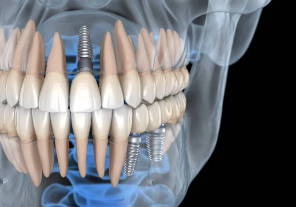 Fogpótlás Implantátummal Röntgenkép Orvosilag Pontos Illusztráció Emberi Fogak Műfogsor Koncepció — Stock Fotó