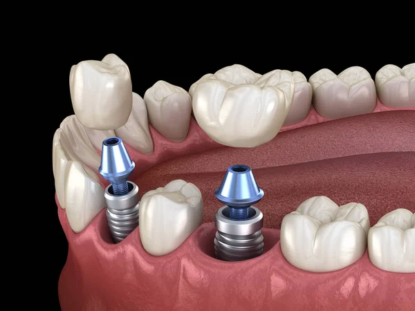インプラントの上に前歯と臼歯の歯冠のインストール 人間の歯や入れ歯の3Dイラスト — ストック写真