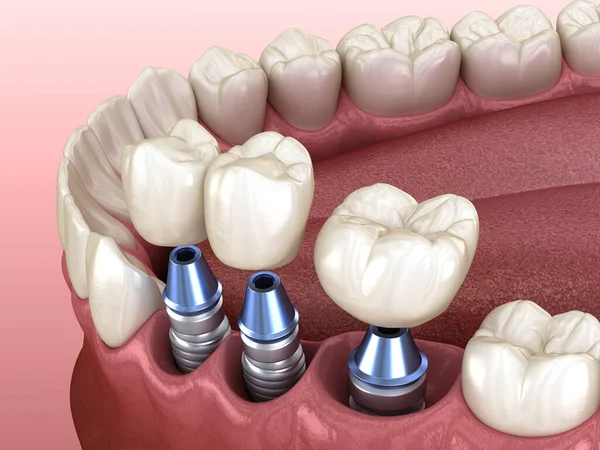 3 tooth crowns placement over 3 implants - concept. 3D illustration of human teeth and dentures