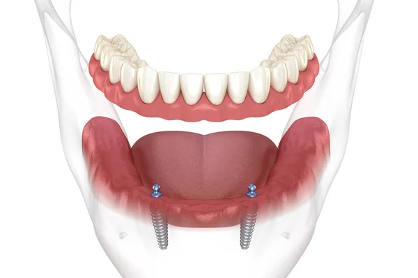 Alt Çene Çıkarılabilir Protez Hepsi Top Eklentili Implantlar Tarafından Desteklenen — Stok fotoğraf