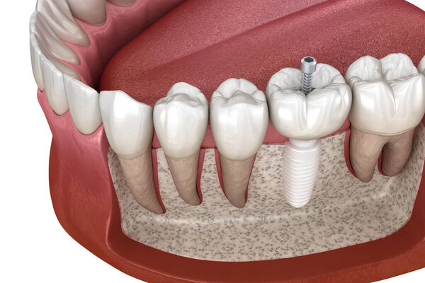 Molar tooth crown installation over ceramic implant. Medically accurate 3D illustration of dental implantation