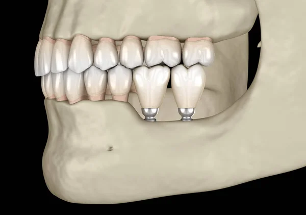 Implantation Mini Implants Recessed Jaw Bone Medically Accurate Illustration — Stock Photo, Image