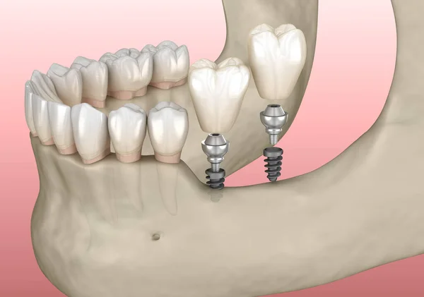 口腔颌骨植入小植入物 医学上准确的三维图像 — 图库照片