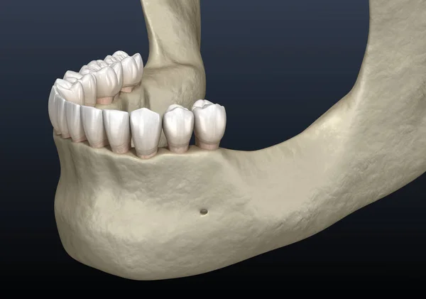 Mandibulární Čelist Kostní Recese Ztrátě Zubů Lékařsky Přesná Zubní Ilustrace — Stock fotografie