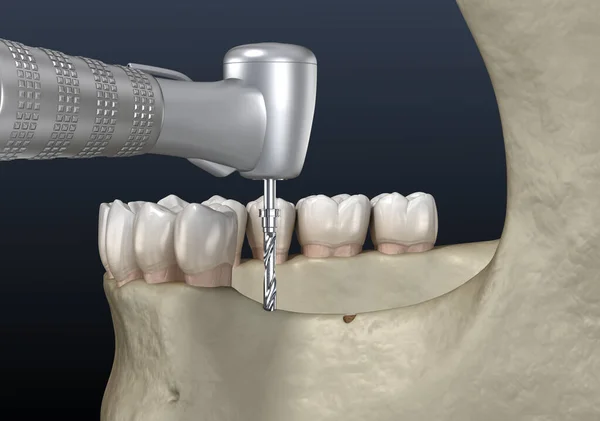アルベロールの尾根の切断 歯科手術 3Dイラスト — ストック写真